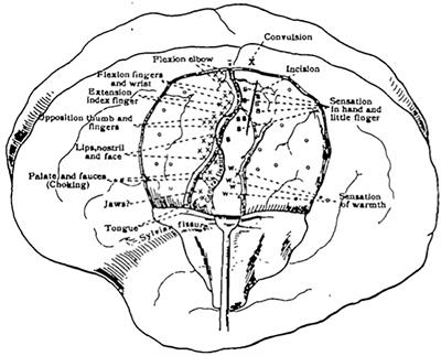 Understanding Variable Motor Responses to Direct Electrical Stimulation of the Human Motor Cortex During Brain Surgery